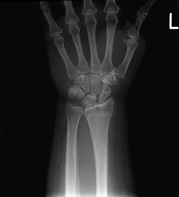 Left Wrist Radiograph (Colles' Fracture)
